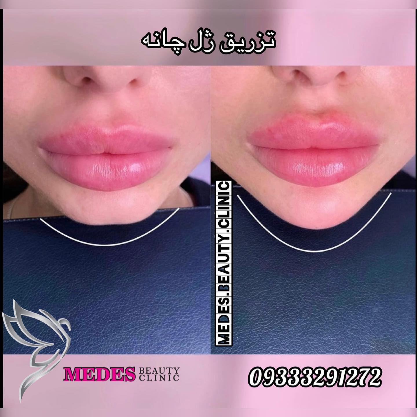 گالری زاویه سازی صورت